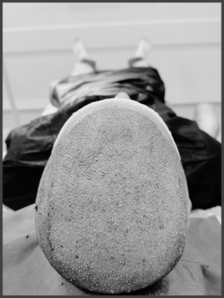 Norwood Scale of Baldness