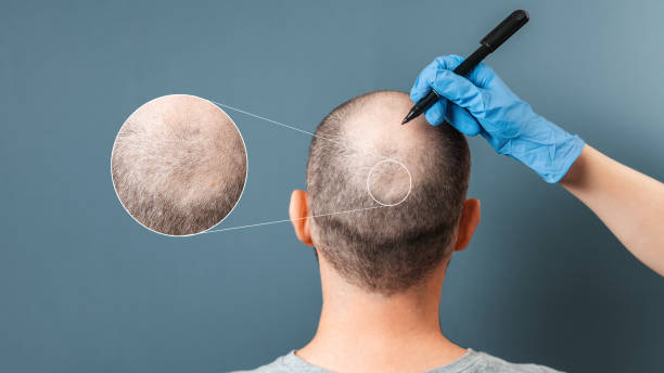 hair transplant uk