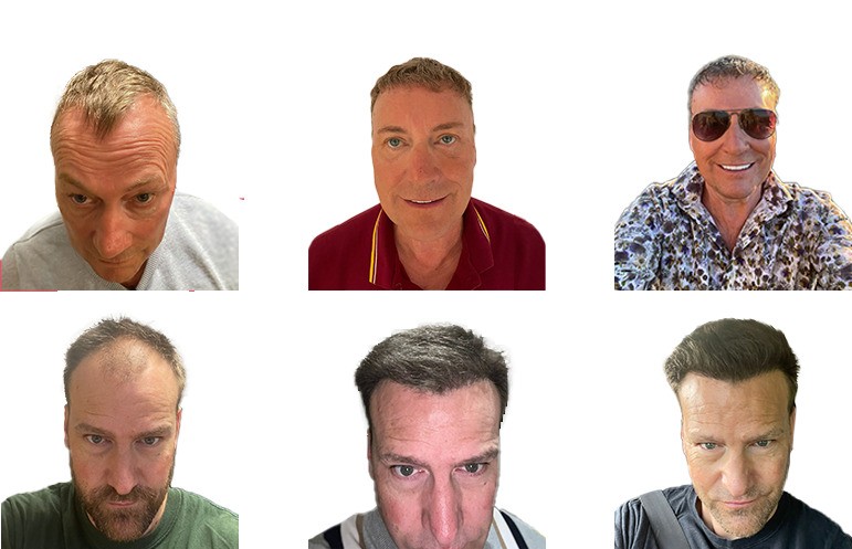 Hair Transplant Treatment